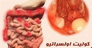 مقاله و مبانی نظری اثر بخشی درمان مبتنی بر پذیرش و تعهد بر معنای زندگی و احساس کهتری بیماران کولیت اولسروز